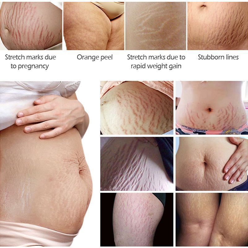Stretch Marks Removal Essential Oil – Tea Tree Infused Body Care