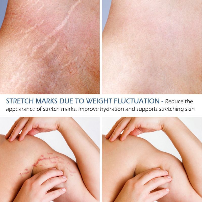Stretch Marks Removal Essential Oil – Tea Tree Infused Body Care