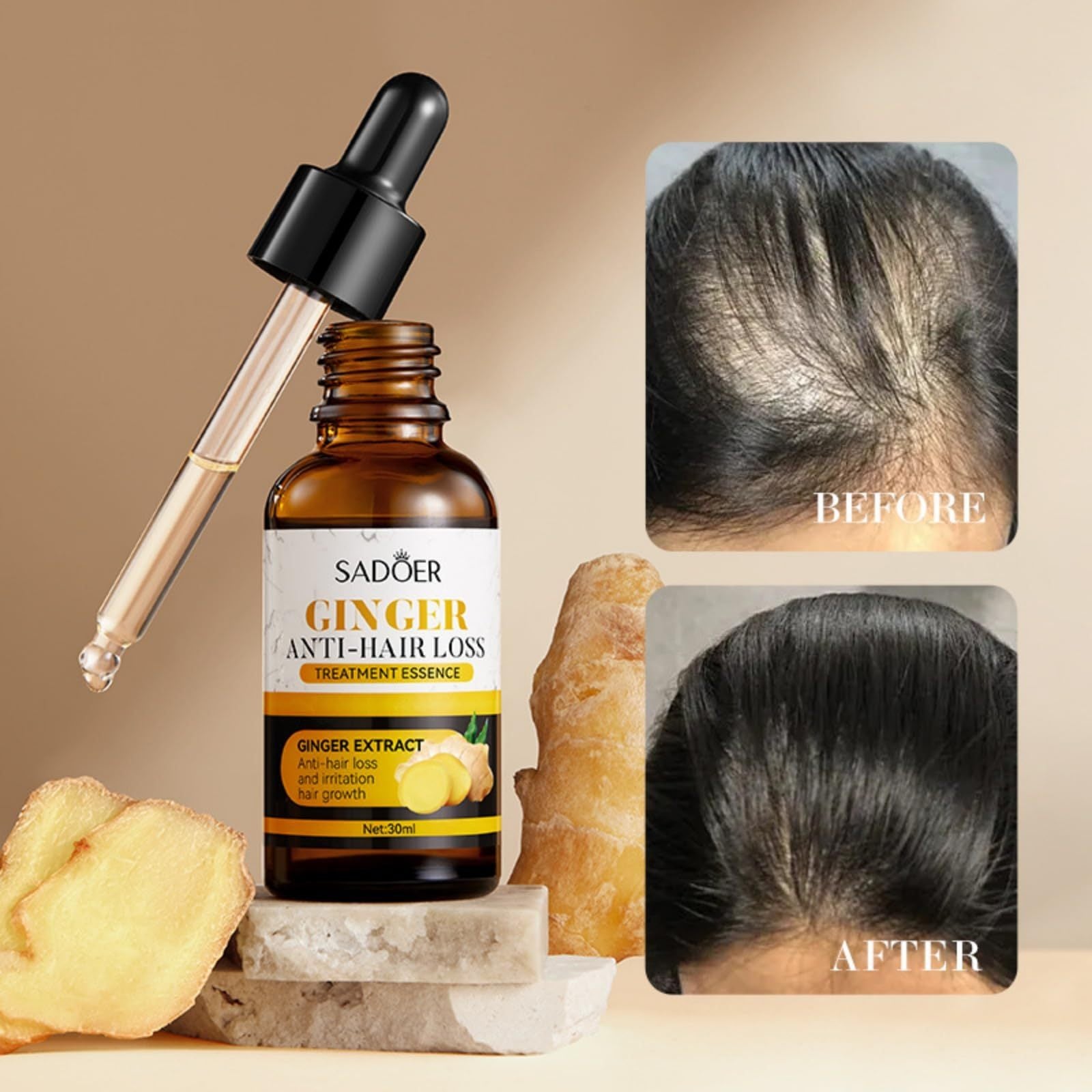 Sadoer Ginger Anti-Hair Loss Treatment Essence bottle with dropper, ginger root, and before-and-after hair comparison on a beige background.