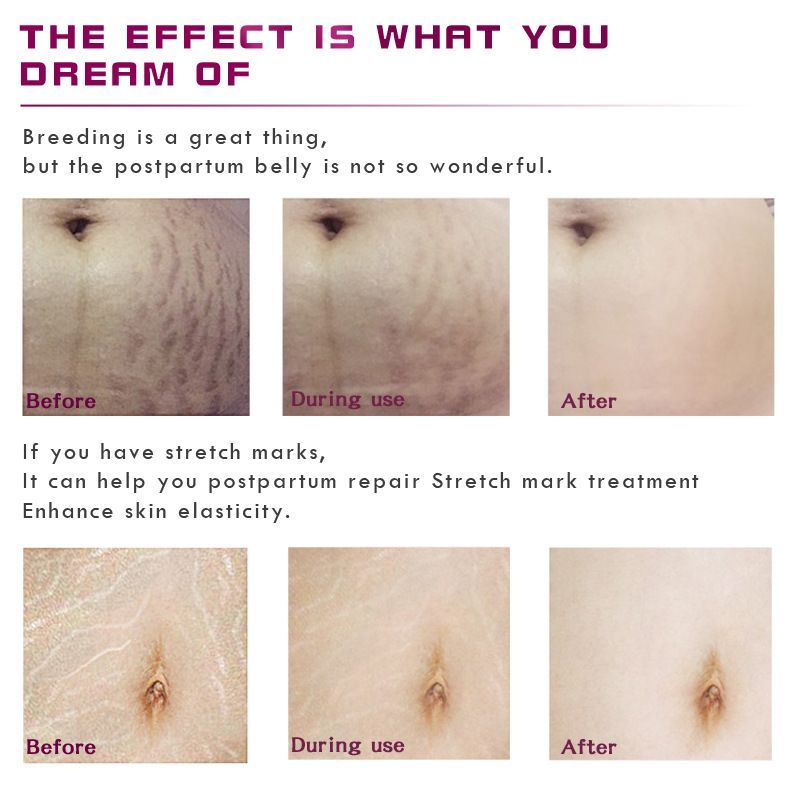 Stretch Marks Removal Essential Oil – Tea Tree Infused Body Care