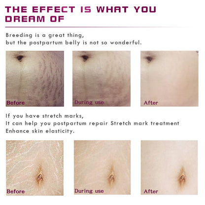 Stretch Marks Removal Essential Oil – Tea Tree Infused Body Care